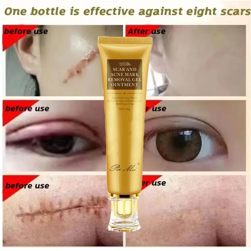 Fast Scar Removal Cream Effective Treatment Stretch Marks Burn Surgical Scars Acne Spot Repair Whiten Moisturize Herbal SkinCare