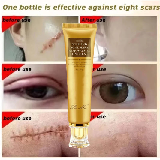 Fast Scar Removal Cream Effective Treatment Stretch Marks Burn Surgical Scars Acne Spot Repair Whiten Moisturize Herbal SkinCare
