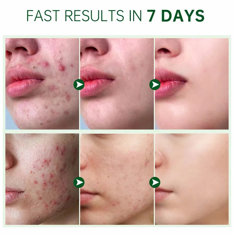 Salicylic Acid Acne Treatment Face Serum Repair Pimple Spots Deep Cleaning Pore Anti-acne Scar Oil Control Moisturizer Skin Care
