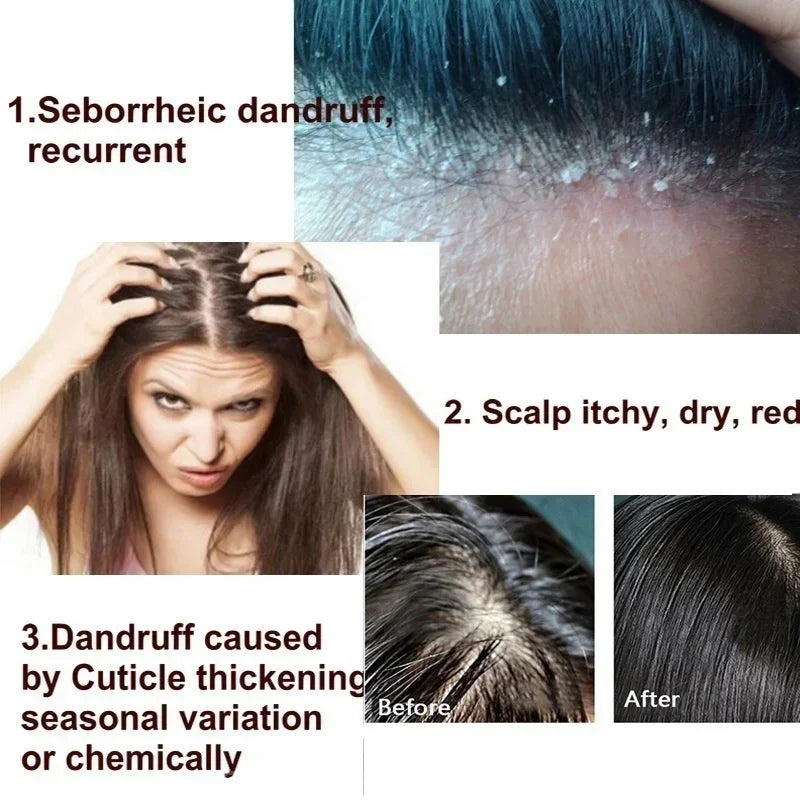 Fast Anti Dandruff Hair Treatment Scrub Itching Repair Scalp Cleaning Exfoliating Products Oil Control Antipruritic Hair Care