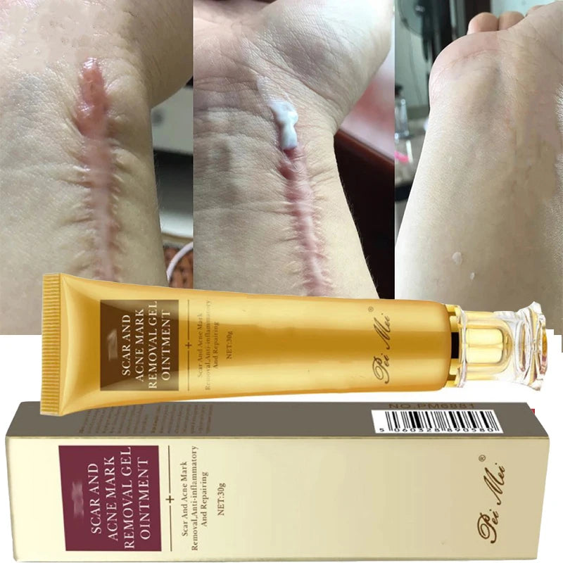 Fast Scar Removal Cream Effective Treatment Stretch Marks Burn Surgical Scars Acne Spot Repair Whiten Moisturize Herbal SkinCare