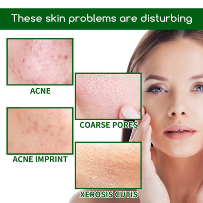 Salicylic Acid Anti Acn-e Serum Essence Controls Oil Shrinks Pores Removes Blackheads & Acne Repairs Acne Marks Moisturizes Face