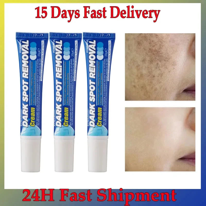 Effective Whitening Freckles Face Cream Remove Melasma Dark Spots Fade Pigmentation Acne Scars Moisturizing Brighten Beauty Care