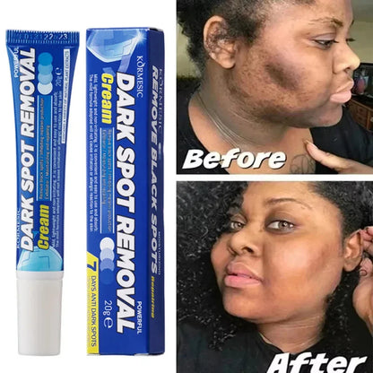 Effective Whitening Freckles Face Cream Remove Melasma Dark Spots Fade Pigmentation Acne Scars Moisturizing Brighten Beauty Care
