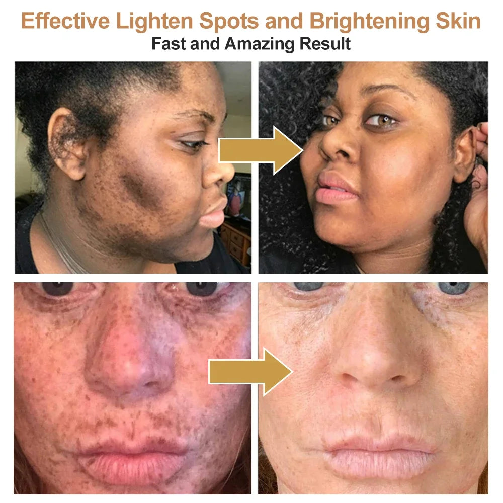 Turmeric lemon Skin Care products Acne Dark Spot Remover Whitening Brighten Facial Serum Face Cream Cleanser Serum Oil Cosmetics