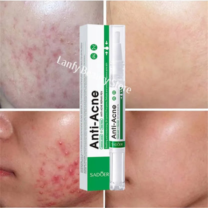 Salicylic Acid Acne Treatment Face Serum Repair Pimple Spots Deep Cleaning Pore Anti-acne Scar Oil Control Moisturizer Skin Care