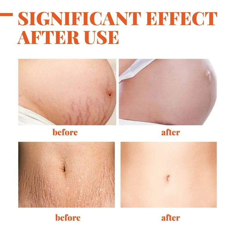 Removes Stretch Mark Cream Postpartum Pregnancy Scars Repair Creams Anti-Aging Anti-Wrinkles Maternity Skin Repair Treatment Body Moisturizing Brighten Skin Care Cream