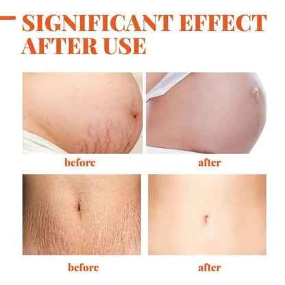Removes Stretch Mark Cream Postpartum Pregnancy Scars Repair Creams Anti-Aging Anti-Wrinkles Maternity Skin Repair Treatment Body Moisturizing Brighten Skin Care Cream