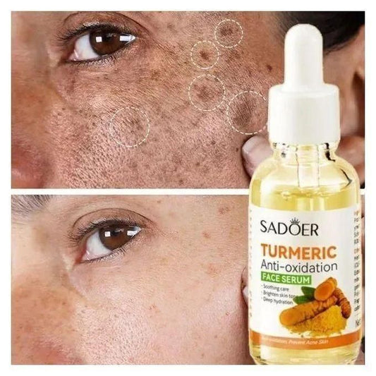 Dark Spot Remover Tumeric Serum, Oil Control Acne Remover Even Skin Tones, Brightening & Anti-Aging Serum -r Even Skin Tones, Improving Skin Tone...