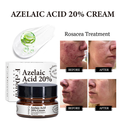 Azelaic Acid 20% Whitening Fades Acne Cream Freckle Remove Melasma Dark Pigment Spots Melanin Alpha Arbutin Face Cream Skin Care