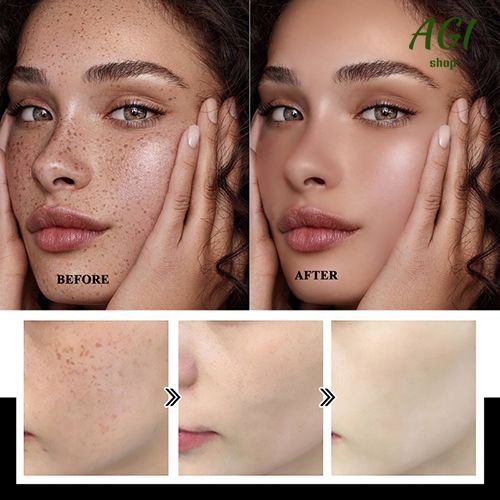 Face Skin Care Set Nicotinamide Whitening Freckles Cream + Facial Cleanser + Moisturizing lotion + Face Essence + Face Toner + Masks 5 Pcs Remove Melasma Dark Spot Acne Marks Brightening Skin Tone