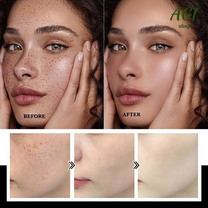 Face Skin Care Set Nicotinamide Whitening Freckles Cream + Facial Cleanser + Moisturizing lotion + Face Essence + Face Toner + Masks 5 Pcs Remove Melasma Dark Spot Acne Marks Brightening Skin Tone