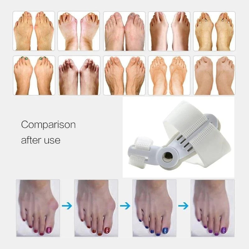 Orthopedic Bunion Corrector 1 PCS Hallux Valgus Brace Splint Pads Bunion Big Toe Separators Straightener Universal for Left and Right Feet