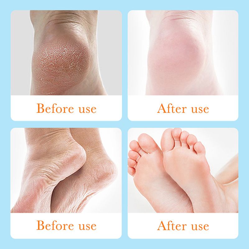 Foot Anti Chapped Gel,Moiturizing the skin,Softening keratin,Smoothing tender feet