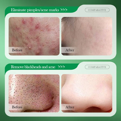 Salicylic Acid Acne Treatment Pads and Face Mask