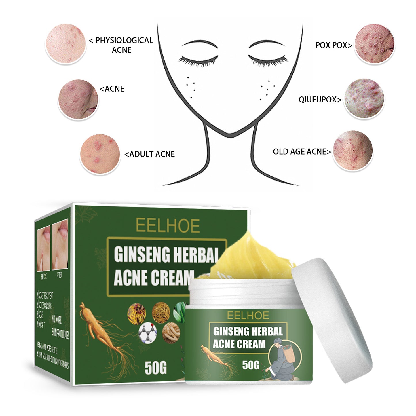 Acne Removal Cream Face Cream for Pimples and Black Spots Product for Acne Ginseng Herbal Acne Skin Care Best Moisturizer for Acne Prone Skin