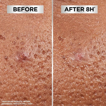 Garnier Pure Active 8hr Invisible Pimple Patch, Enriched with Hydrocolloid that Reduce Pimple Size in 8 hours