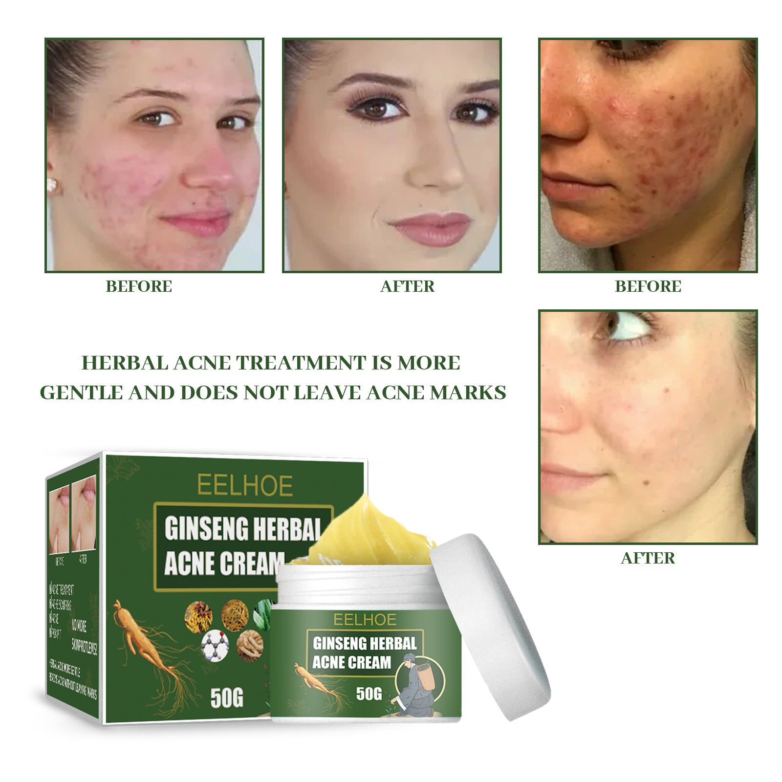 Acne Removal Cream Face Cream for Pimples and Black Spots Product for Acne Ginseng Herbal Acne Skin Care Best Moisturizer for Acne Prone Skin