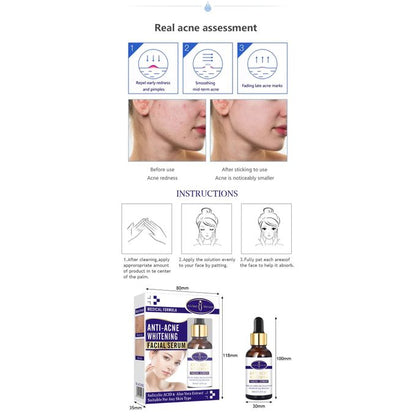 Aichun Beauty Anti-Acne Whitening Facial Serum With Salicylic Acid & Aloe Vera Extracts Face Skin Care