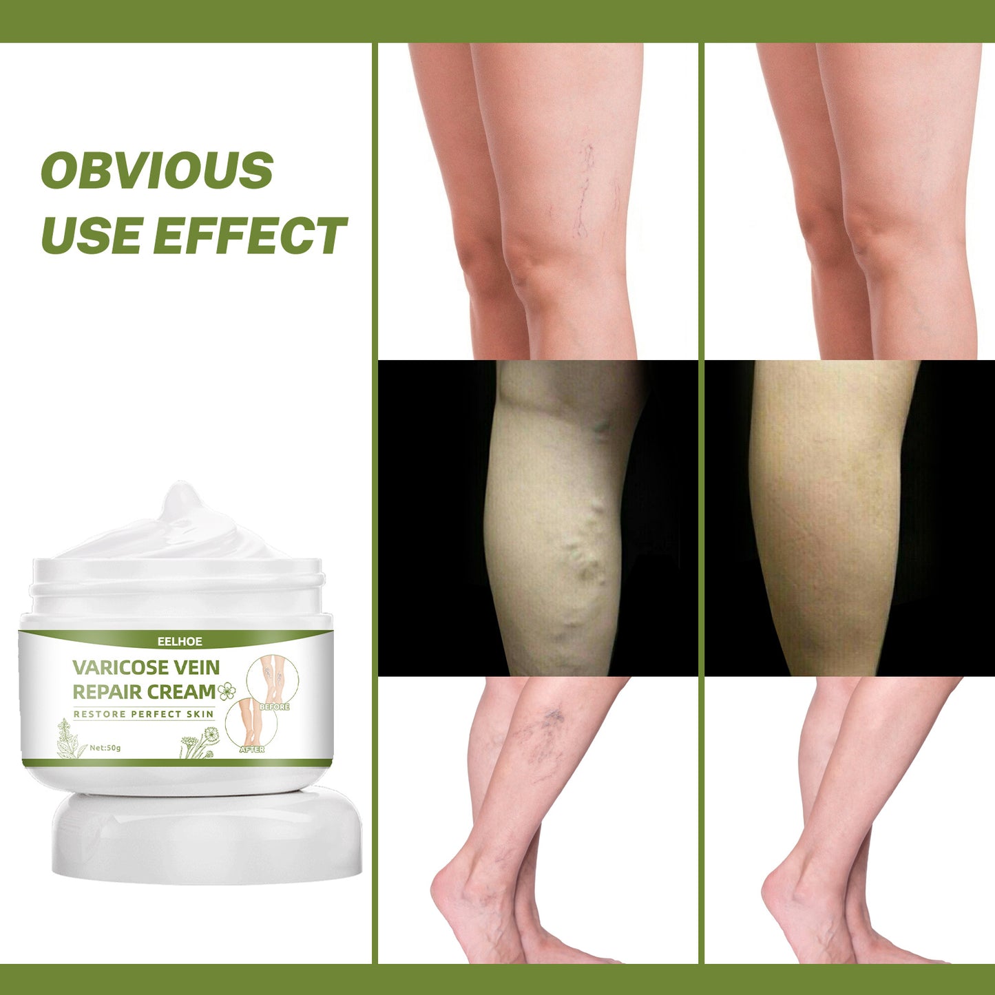Varicose Veins Repair Cream Spider Varicose Vein Treatment Cream Vein Healing Ointment Improving Blood Circulation Leg Repair Gel