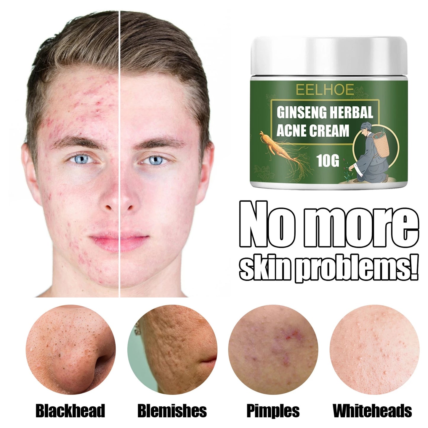 Acne Removal Cream Face Cream for Pimples and Black Spots Product for Acne Ginseng Herbal Acne Skin Care Best Moisturizer for Acne Prone Skin