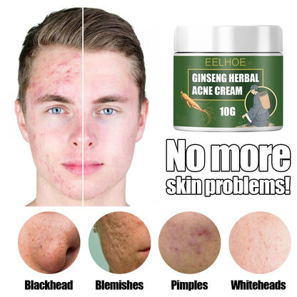 Acne Removal Cream Face Cream for Pimples and Black Spots Product for Acne Ginseng Herbal Acne Skin Care Best Moisturizer for Acne Prone Skin