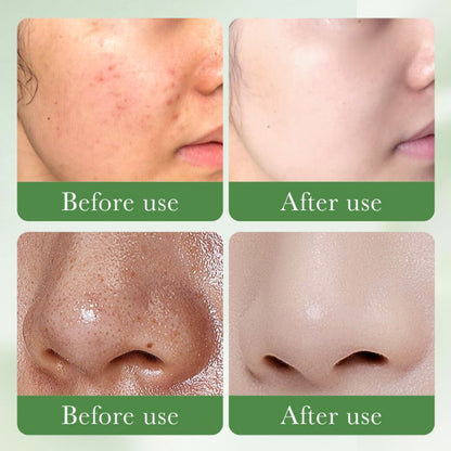 SADOER Face Cleanser, With 3% Salicylic Acid, Niacinamide & Centella Asiatica Collagen Acne Remover Facial Cleanser controls oils, Eliminates Acne, Removes Dirt Like Vitamin C, smoothens, hydrates