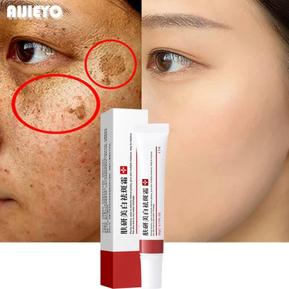 Dark Spot Removal Cream Whitening Freckle Cream Remove Melasma Cream Remove Dark Spots Melanin Melasma Remover Brighten Skin Anti-Aging Skin Lightening