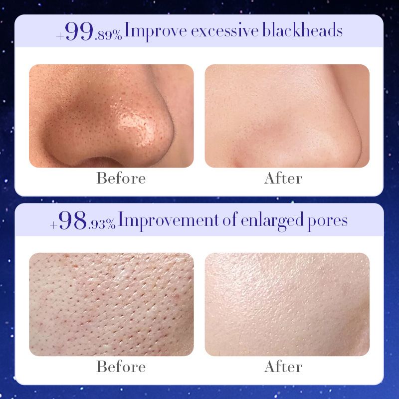 Starry Peel-Off Mask – Removes Blackheads, Acne, and Dead Skin Cells