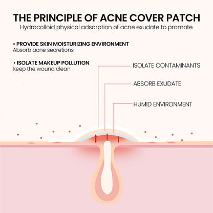 200pcs Repair Acne Patch Facial Skin Care Fade Blemishes Pimple Marks Closed Acne Blemishes Cover Acne Pimple Repair Patch