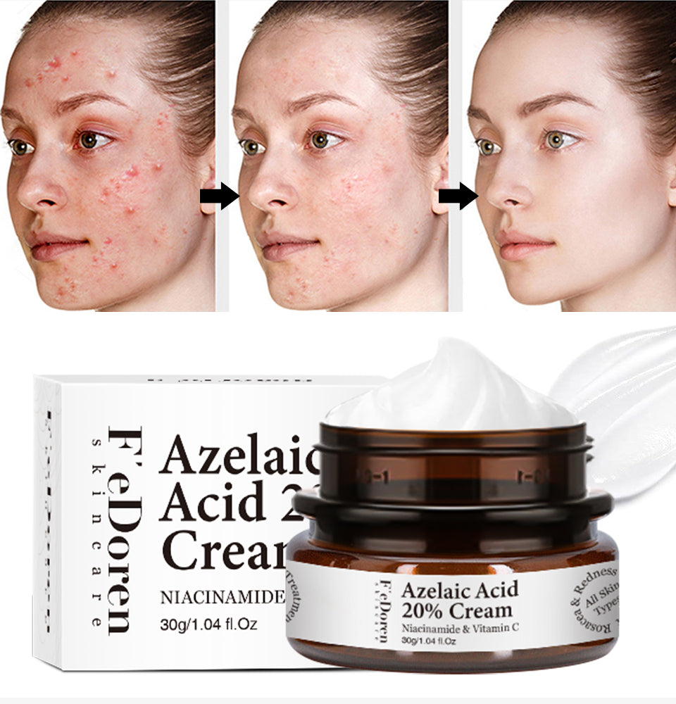 Azelaic Acid 20% Whitening Fades Acne Cream Freckle Remove Melasma Dark Pigment Spots Melanin Alpha Arbutin Face Cream Skin Care