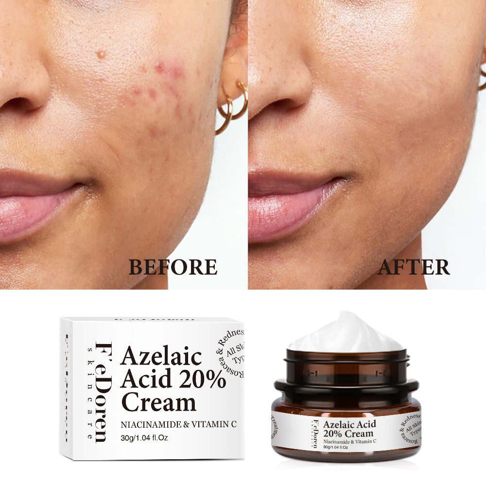 Azelaic Acid 20% Whitening Fades Acne Cream Freckle Remove Melasma Dark Pigment Spots Melanin Alpha Arbutin Face Cream Skin Care