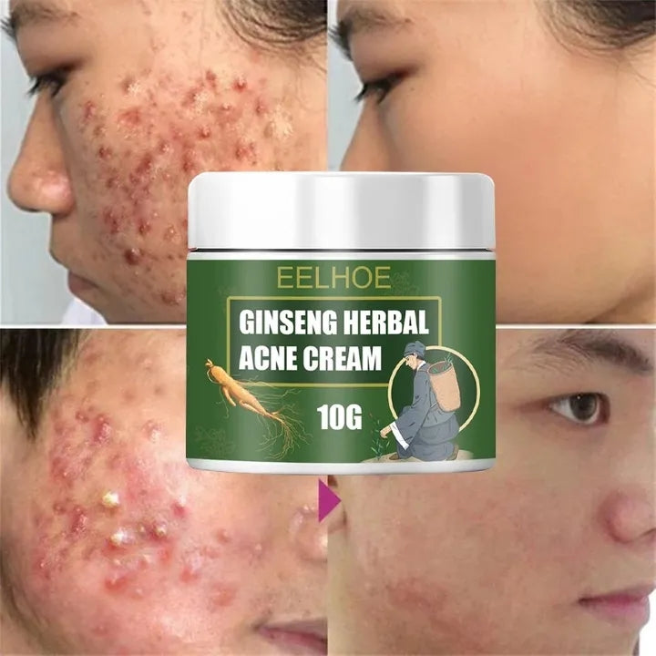 Acne Removal Cream Face Cream for Pimples and Black Spots Product for Acne Ginseng Herbal Acne Skin Care Best Moisturizer for Acne Prone Skin
